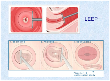 宫颈锥切手术全过程图片