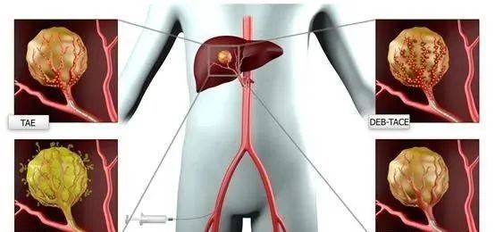 中晚期肝癌首选介入微创治疗