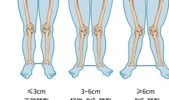 宝宝典型腿型有哪些？影响因素在哪里？细节很关键