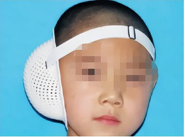 小耳畸形余文林科普:耳再造二期术后护理_全耳_再造术_耳部