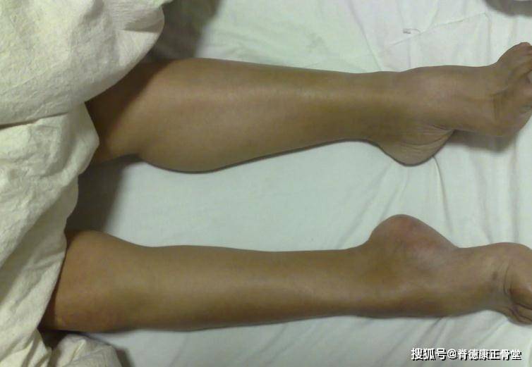 小腿肌肉萎缩了怎么能恢复几种小腿肌肉萎缩康复的方法