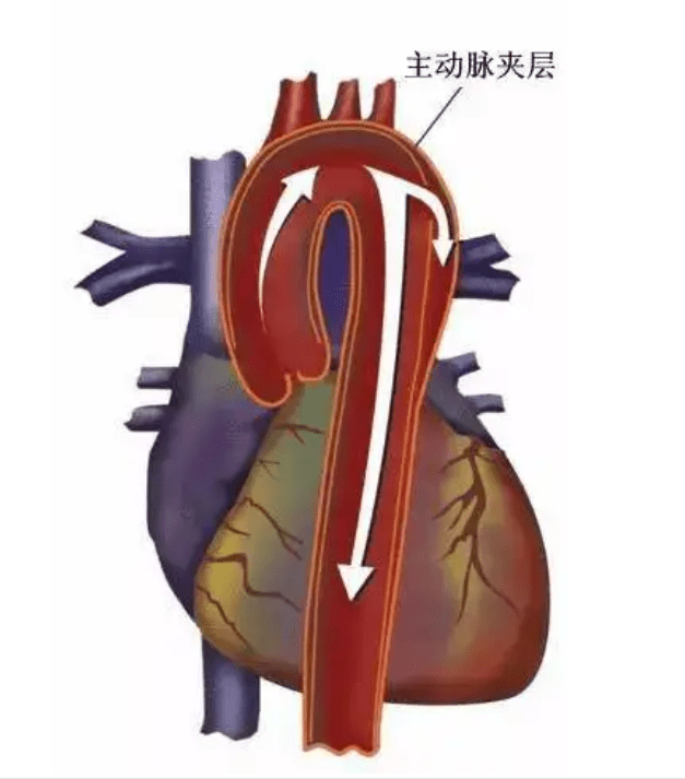 淄博市中心醫院成功救治重症a型主動脈夾層患者