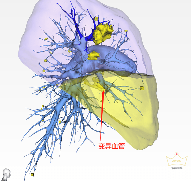 右肺支气管三维图图片