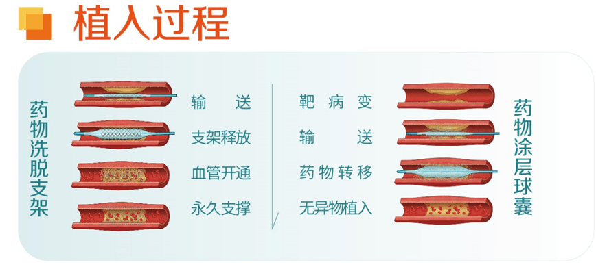 vesselin药物球囊作为"介入无植入"理念产品之一,与传统的金属支架
