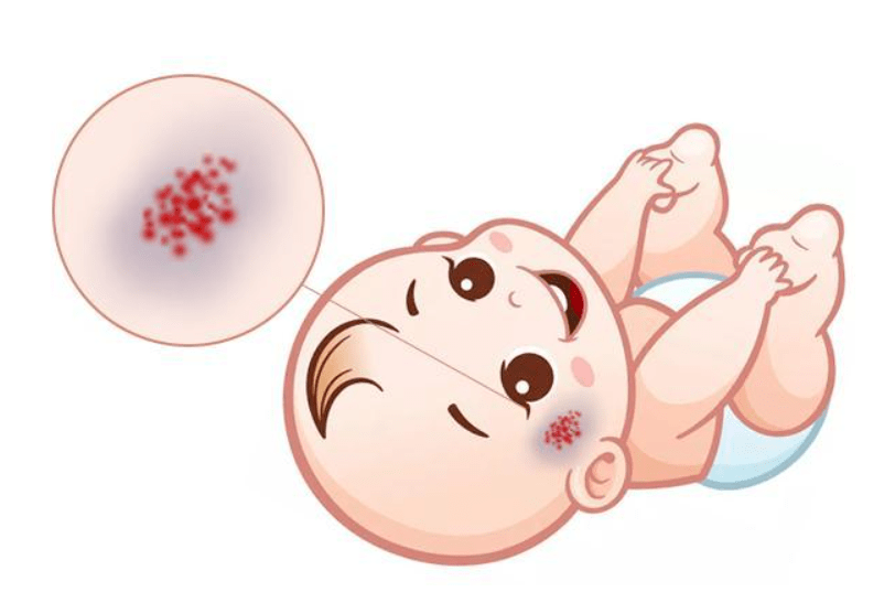 婴儿红斑与血管瘤区别图片
