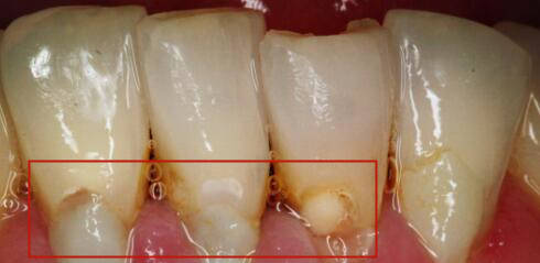 樹脂修復牙頸部出現明顯的