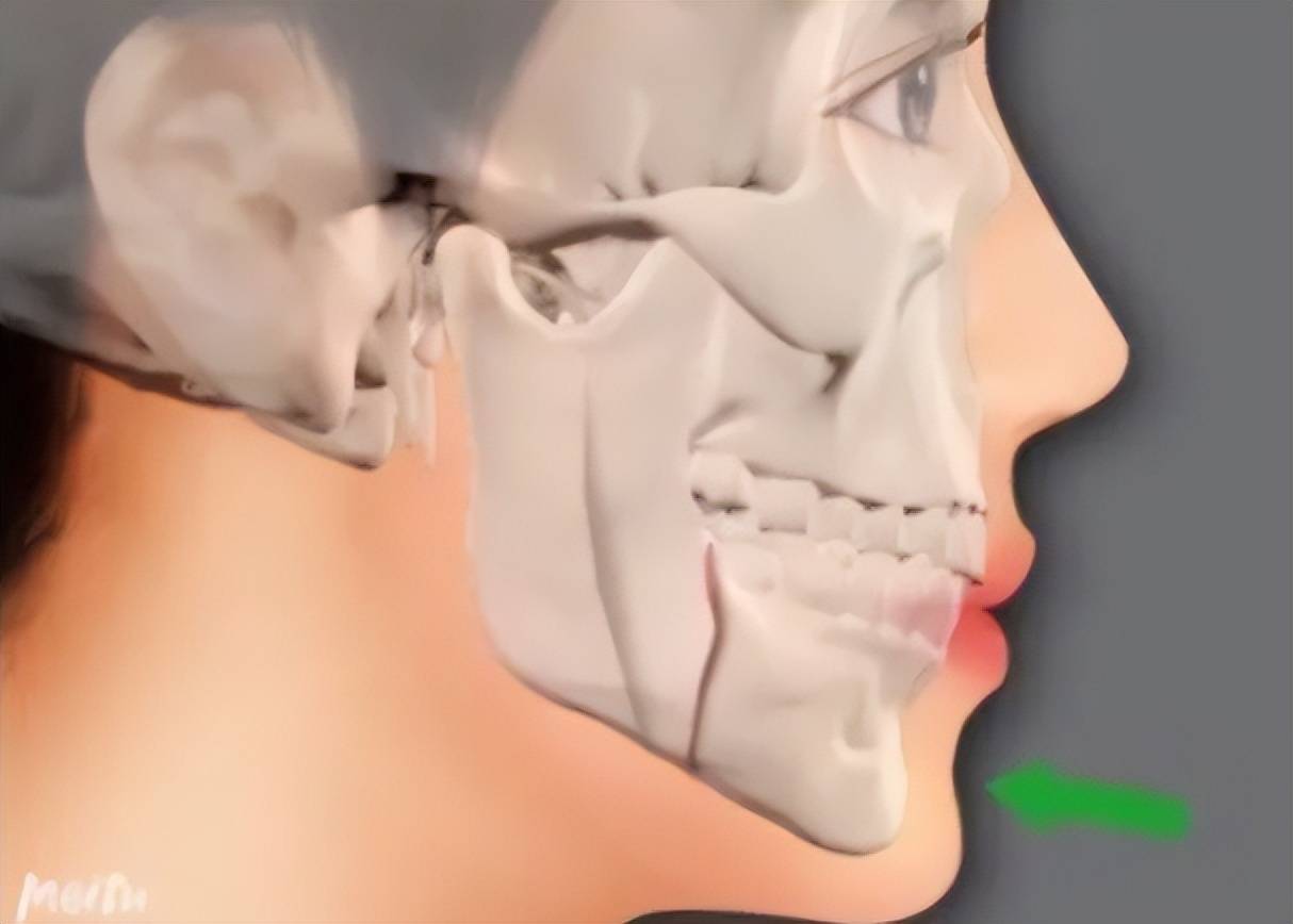 咨询削骨手术多少钱有风险吗削骨手术死亡率大吗