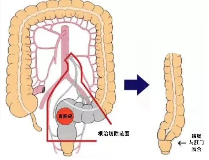 西安马应龙肛肠医院大肠外科成功完成一例超低位直肠癌根治术
