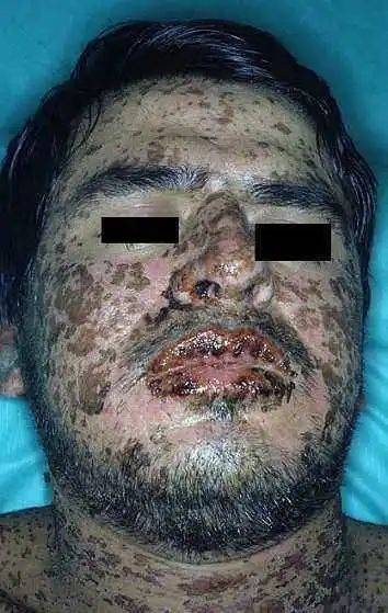 箹诗工坊谨防用生命与健康治疗痘痘谈维a酸的药害事件