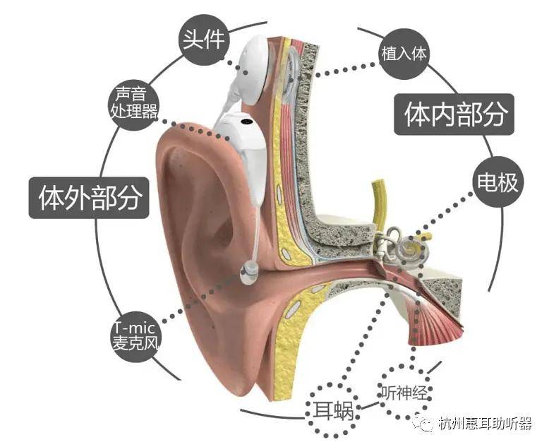 綦江惠耳听力与您分享人工耳蜗可以改善听力究竟什么是人工耳蜗呢