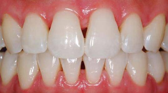 戴牙套后出现"黑三角",牙齿矫正的副作用?_牙龈_牙周_进行