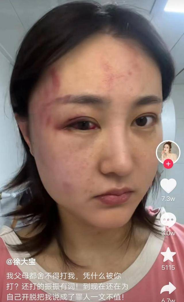 34岁女演员遭家暴,拖进房间打得眼睛红肿充血,绝望发声只为离婚_微博