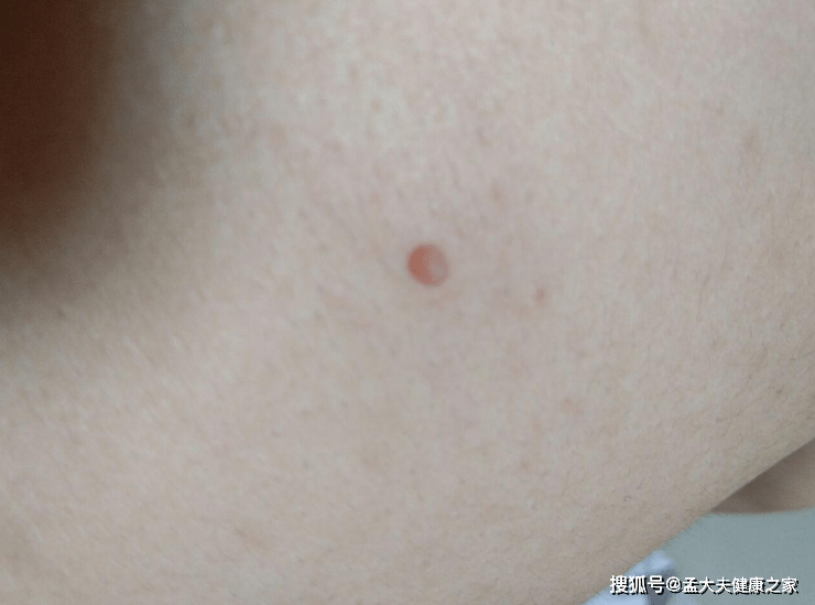 hpv疣是由人乳头瘤病毒(hpv)感染皮肤黏膜所引起的良性赘生物,表面较