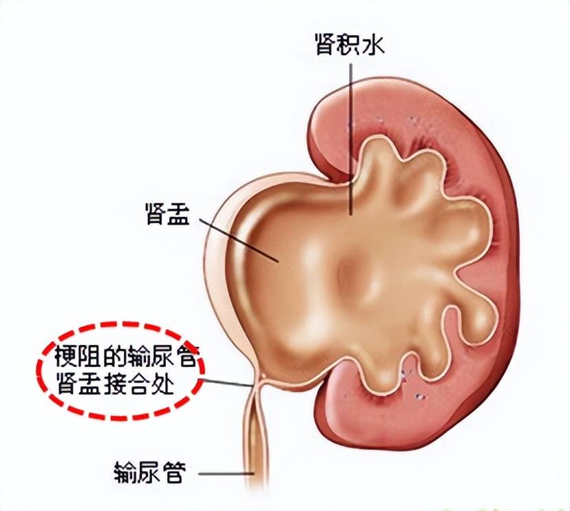 据小儿外科主任,主任医师王胜义介绍:小儿肾积水多数是肾盂输尿管连接
