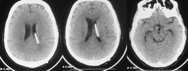 经蝶垂体瘤术后脑脊液鼻漏颅内感染脑积水脑室腹腔分流术失败