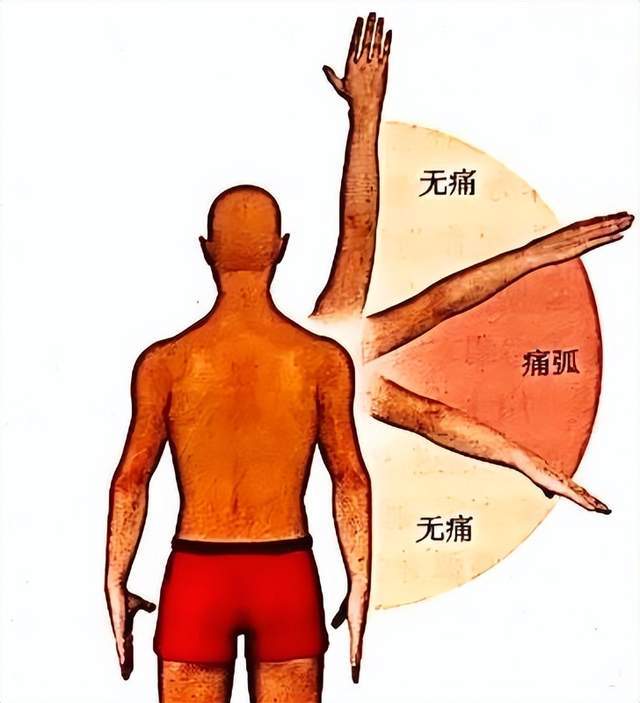 肩袖损伤症状图片