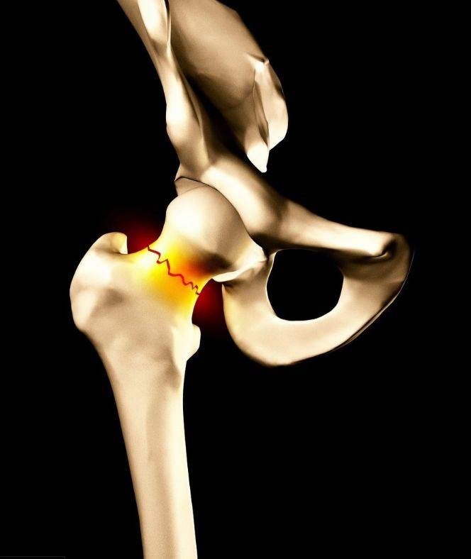 股骨颈骨折——髋关节这里,有两个位置经常发生骨折,一个叫做股骨颈