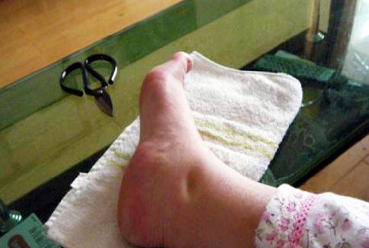 【孕妇脚肿】孕妇脚肿怎么办_孕妇脚肿是什么原因