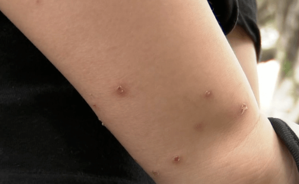 乳源人要当心这些小虫!_蠓虫_蚊子_症状