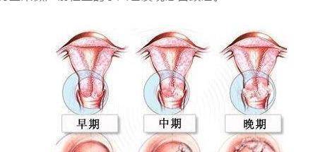 内生型宫颈癌图片图片