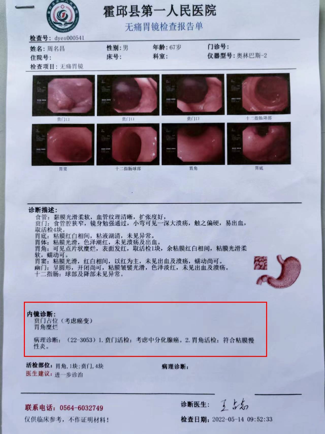 胃癌照片 报告表图片