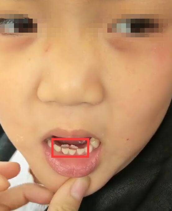 7岁男孩长出双排牙,需要一颗颗拔掉,奶奶自责不已