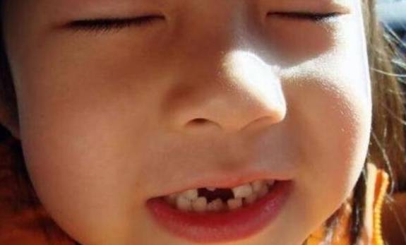 【儿童换牙】儿童换牙要注意什么_儿童换牙长歪了怎么办