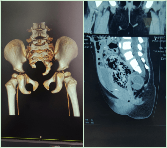据徐珂医生介绍:curarrino综合征是一种由于肛门直肠畸形,骶骨发育