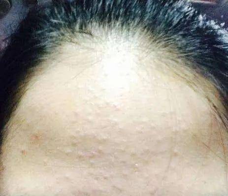 比痘痘更烦人的闭口来了最有效的去闭口大法看过来