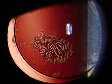 视网膜_患者_玻璃体