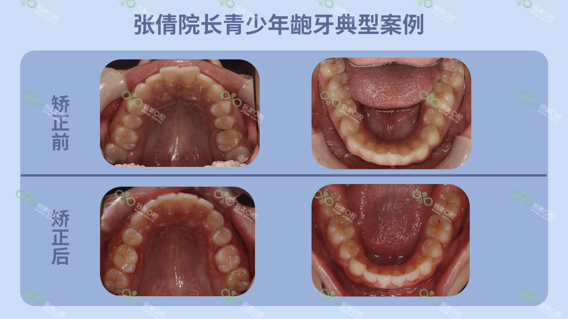 牙齿生长线图片图片