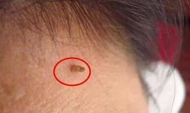 原创脖子和腋下的小肉粒是什么能用手扯下来吗