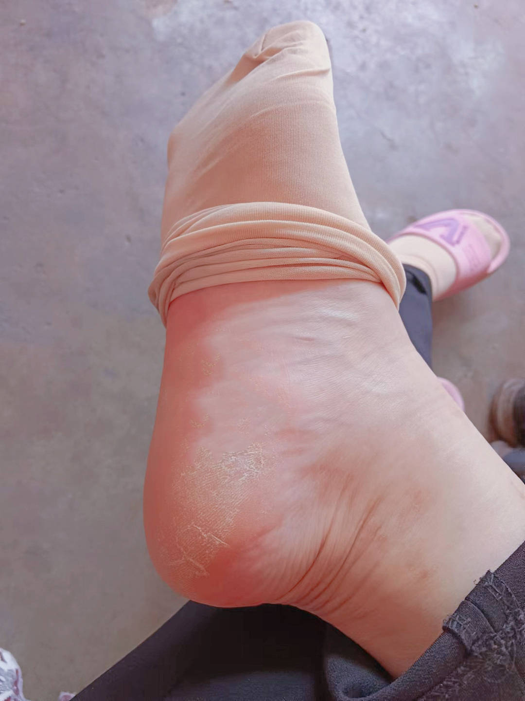 原创为什么脚后跟总是干裂有厚厚的死皮