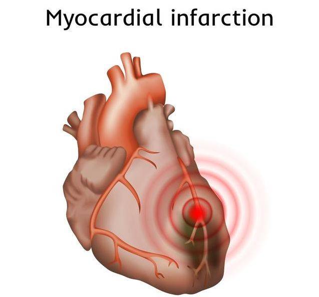 原创心肌梗死能不能治好不能做到三个坚持可以预防心梗再次发生