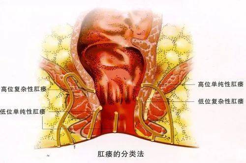 肛瘻是什麼原因?_直腸_肛門_克羅恩