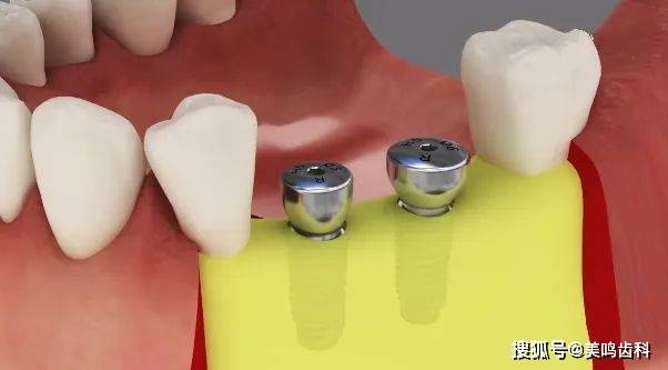 美鸣三代四合一新型愈合基台种植修复的更优选择