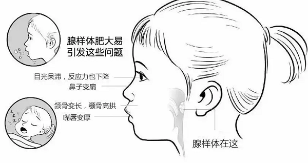 直樂大講堂有這些症狀可能是腺樣體肥大久拖不治會形成痴呆面容