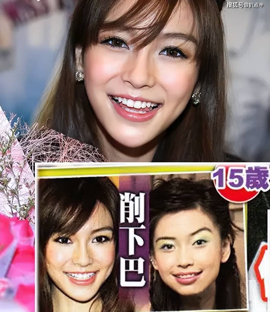 其中最为成功的就是让她戴上牙套,矫正了牙齿