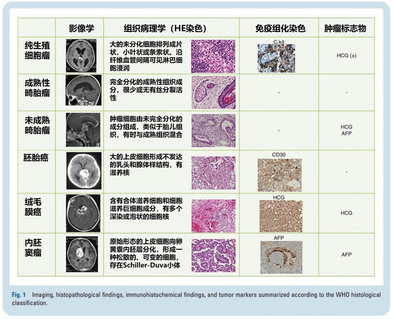 日本神经肿瘤学会原发中枢神经系统生殖细胞肿瘤诊疗指南