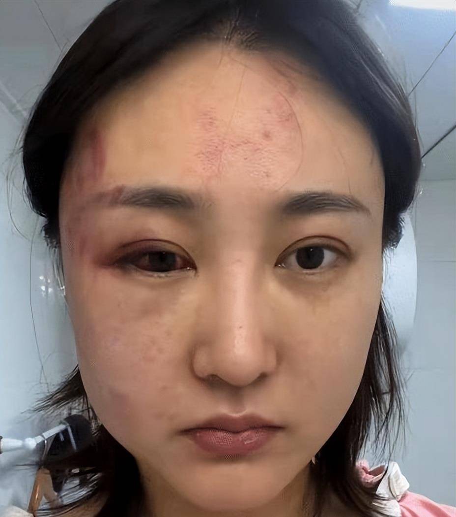 34岁女演员被小5岁丈夫打4次男方称婚后多次出轨真锤证据