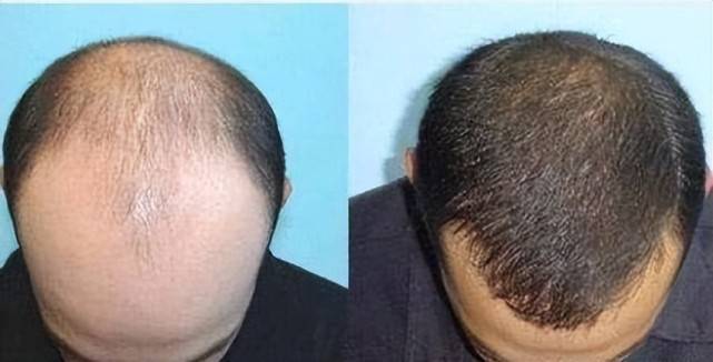 头发能存活多久,植发效果一般能维持多久,太惊人了吧~植发的成活率在