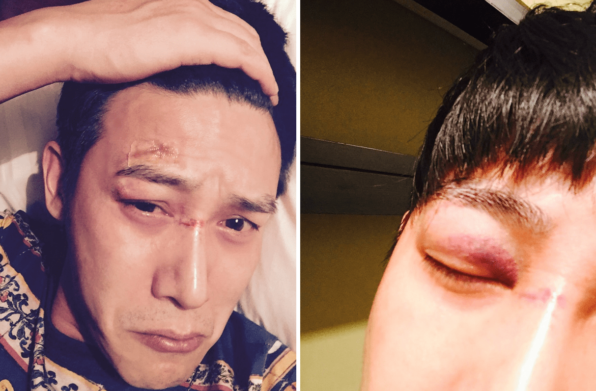 杨幂眼角缝针被担心破相,眼受伤的8位明星李晨流血,谢霆锋留疤_眼睛