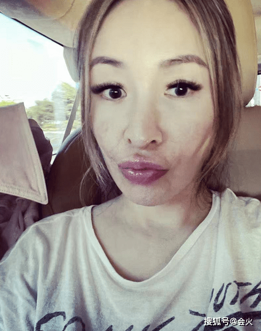 萧亚轩被狗咬后素颜晒疤!下巴布满增生伤痕