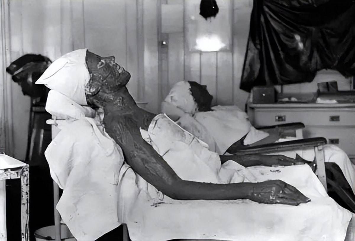 被核辐射后的人受害者图片
