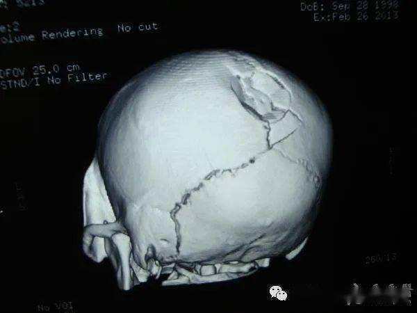 颅骨孔裂图片