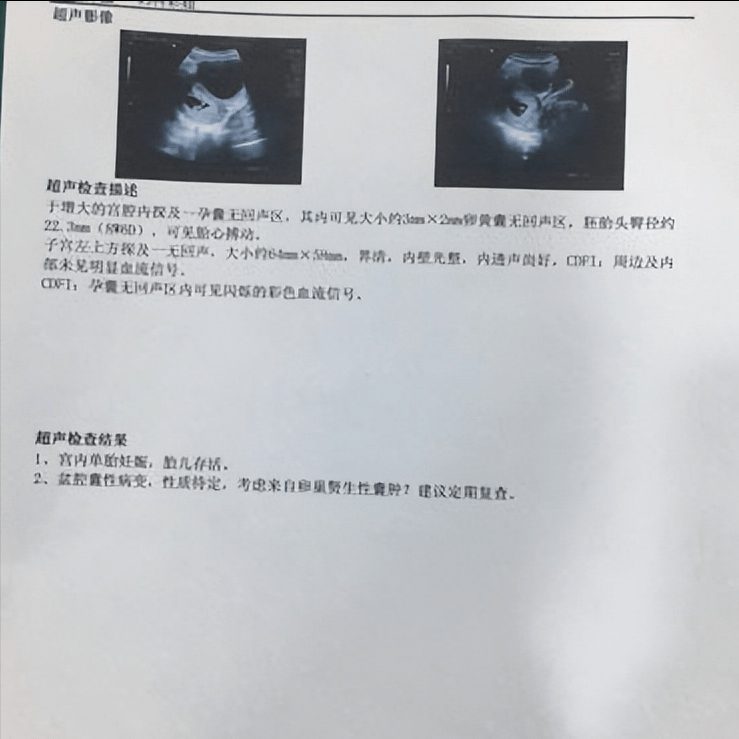 25岁熬夜出现卵巢囊肿中药调理2周囊肿消失