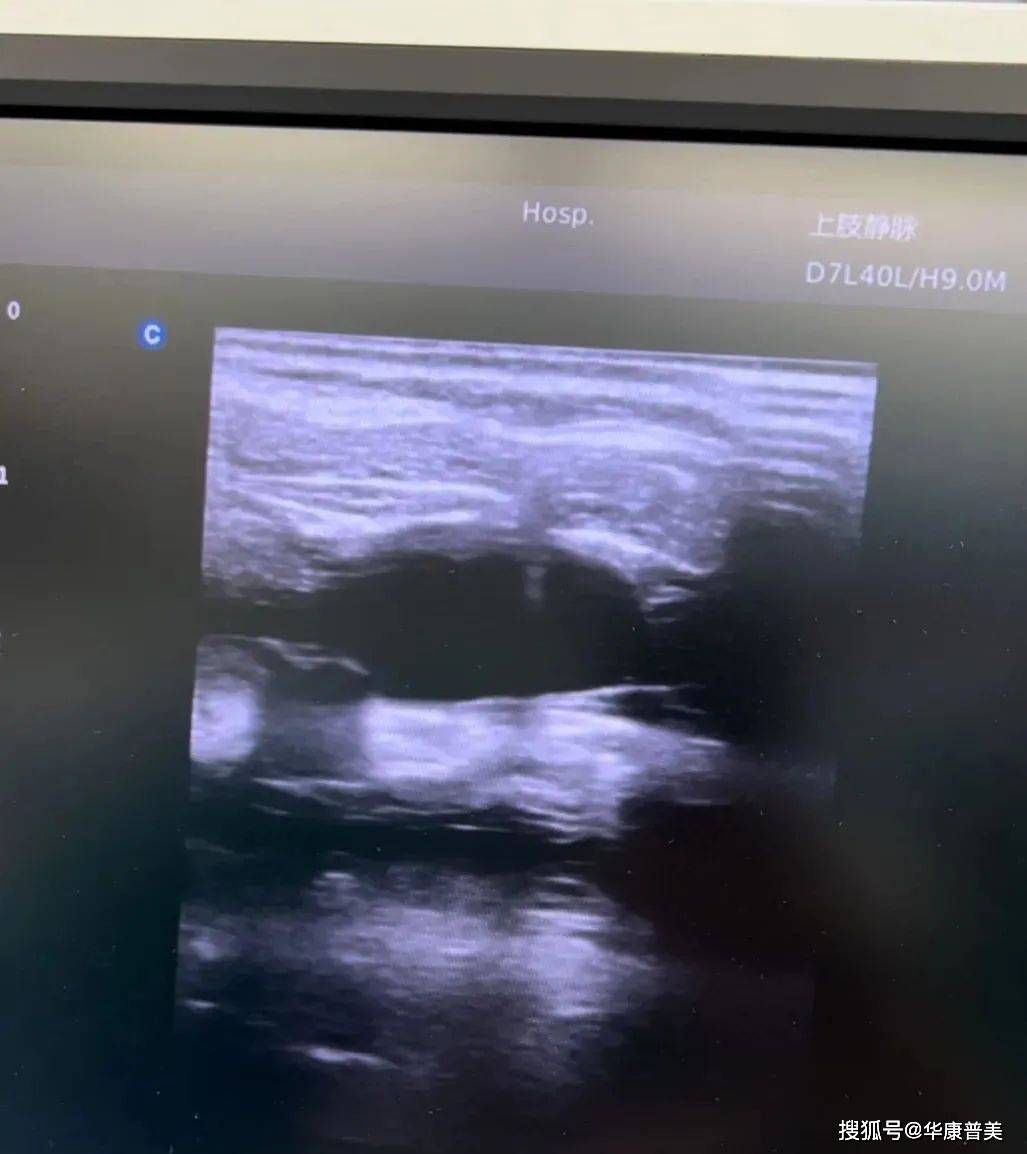 关于中心静脉置管技术你需要知道的那些事儿_锁骨_cm_患者