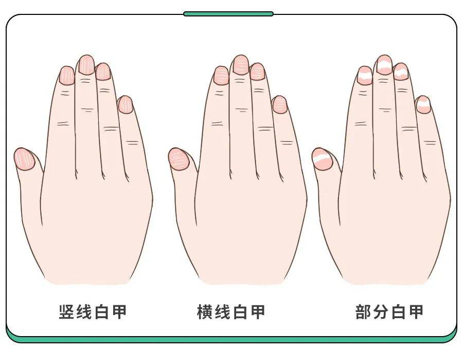 白斑、薄脆、凹陷,娃指甲有异常,不是缺营养,可能暗藏疾病