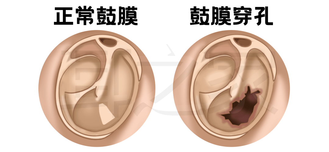 最擔心的事情發生了,一巴掌下去耳朵差點聾了_鼓膜_外耳道_進行