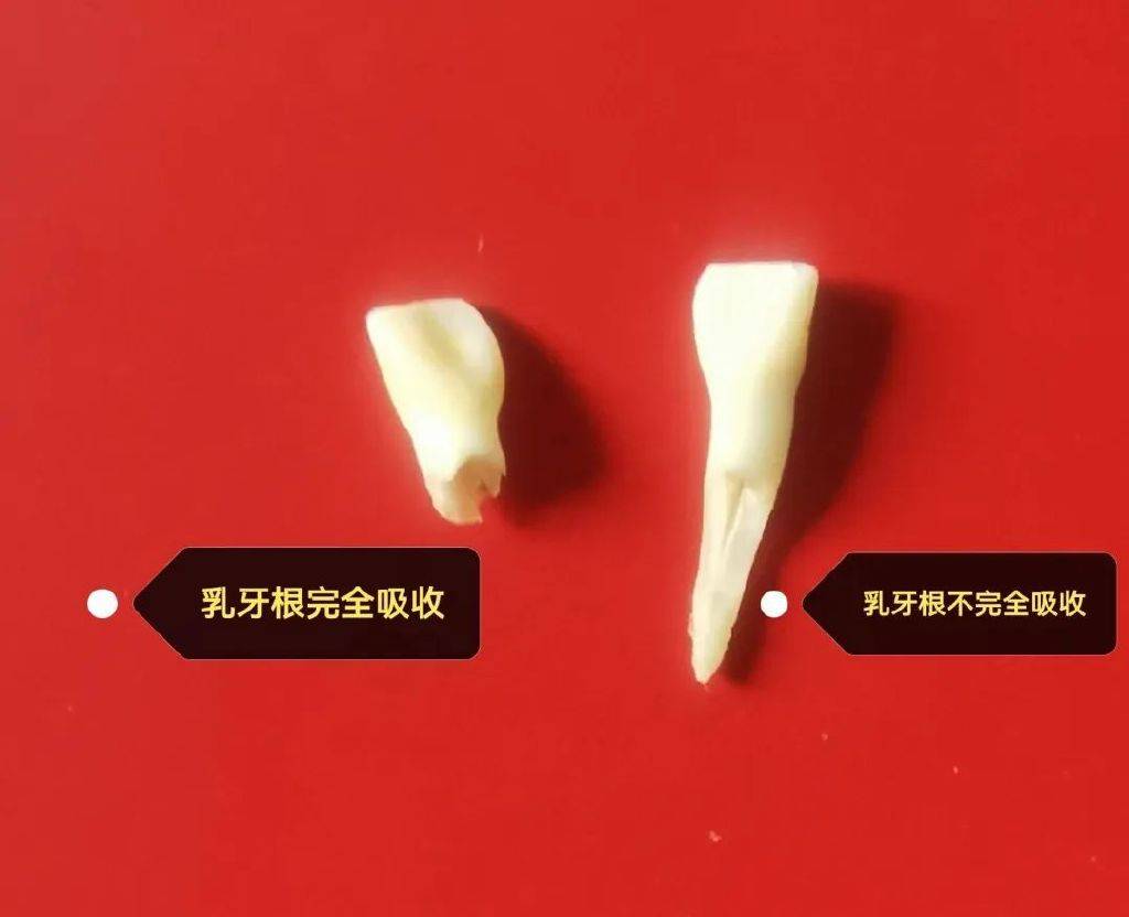 乳牙牙根形状图片